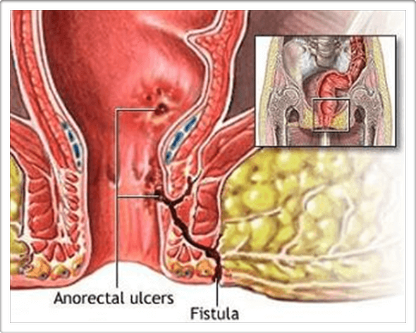 Fistula in Ano