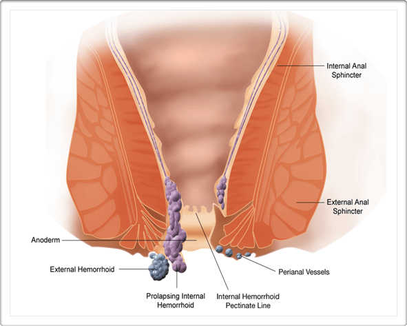 Haemorrhoids