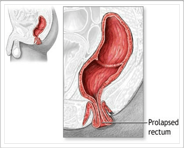 Rectal Prolapse